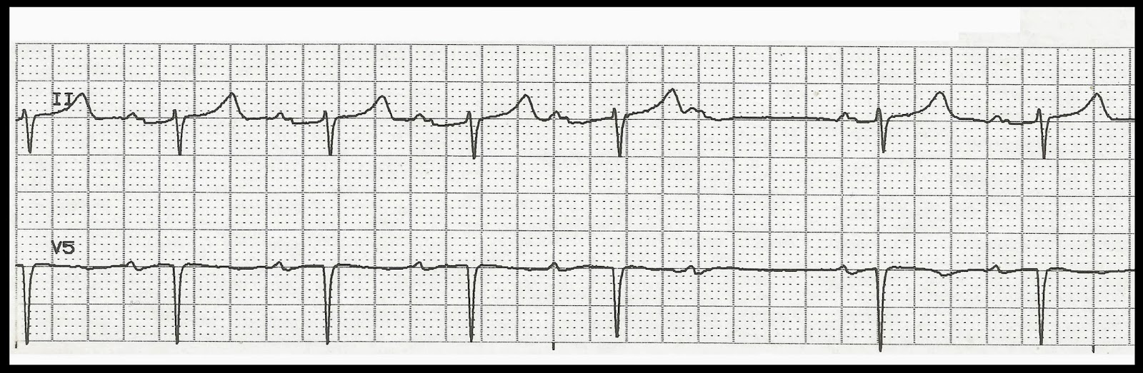 Heart arrhythmia rhythm strip readings Valuable information heart arrhythmia rhythm strip readings you